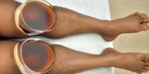 Ayurvedic Treatment For Knee Pain in Domlur